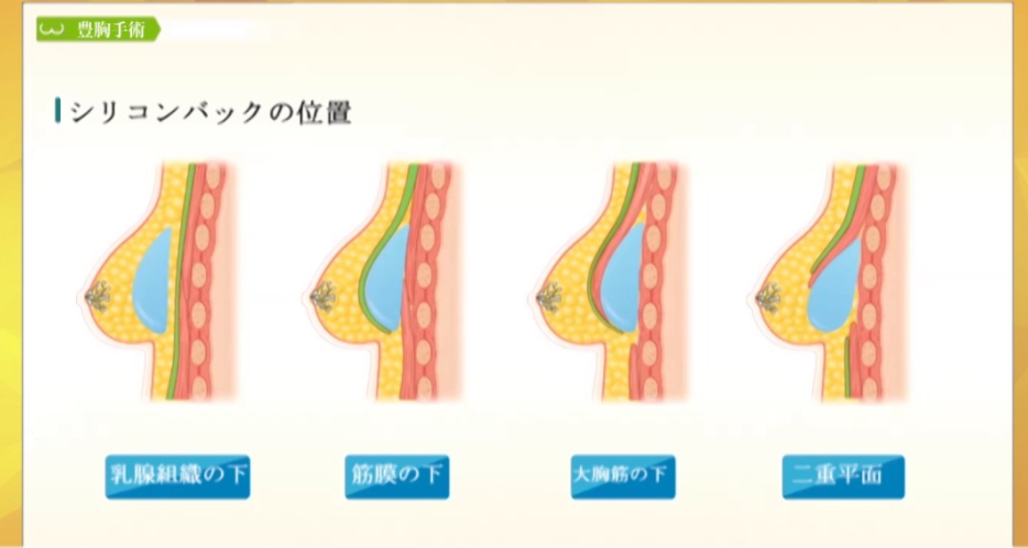 日本最新隆胸技术，革命性突破重塑完美曲线